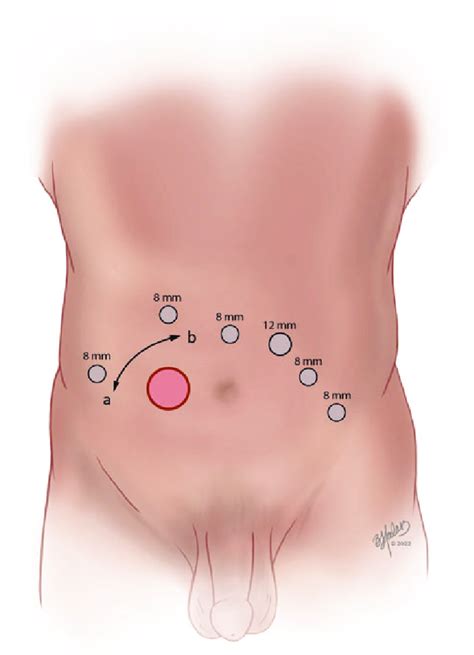 Port placement. Port placement for robotic reimplantation. Please note ...