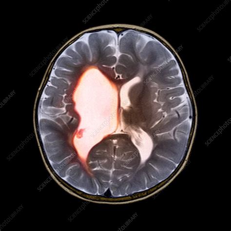 Cerebral Palsy Brain Vs Normal Brain