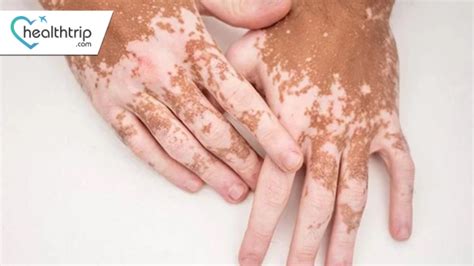 Comprehensive Guide To Vitiligo Treatment In India Top Hospitals