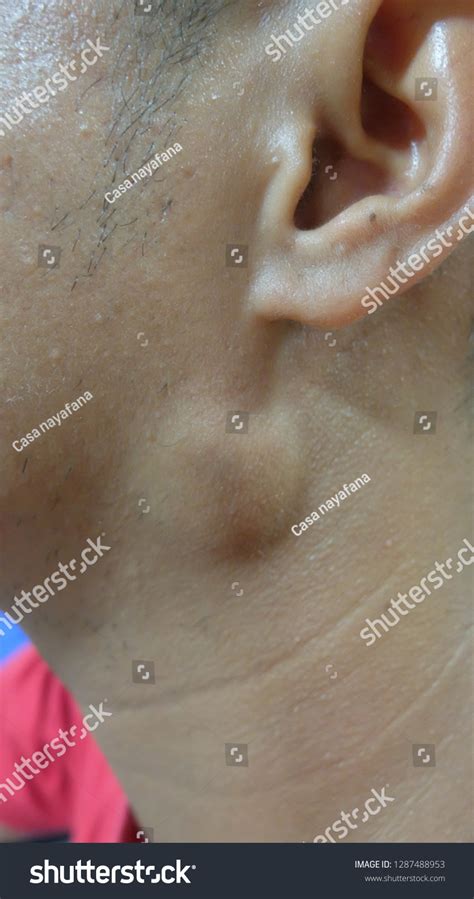 Preauricular Swelling Differential Diagnosis Parotid Swelling Stock