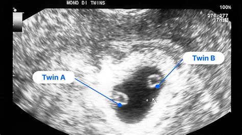 6 Week Pregnancy Ultrasound Yolk Sac Fetal Pole Heartbeat And More