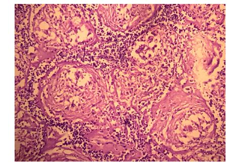 Lung Biopsy Showing Large Non Caseating Granulomas With Tightly Packed Download Scientific