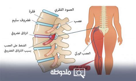 عرق النسا أسبابه، أعراضه، وكيفية علاجه موقع ملحوظة