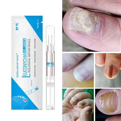 3ML Fungal Nail Treatment Pen Onychomycosis Paronychia Anti Fungal Nail