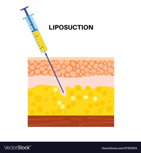 Liposuction Surgery Procedure Royalty Free Vector Image