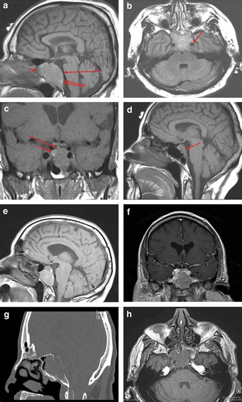 Imaging Of Parasellar Plasmacytomas A Case T Weighted Sagittal