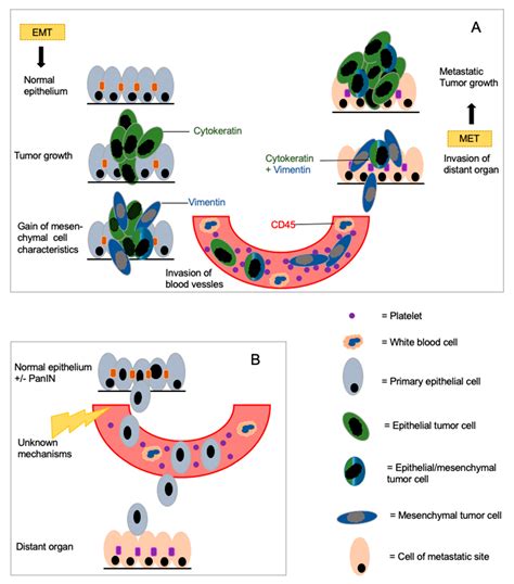 Pancreatic Cancer Metastasis Sites - Study Finds How Pancreatic Cancer ...