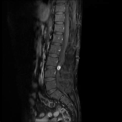 Schwannoma Spine Image Radiopaedia Org