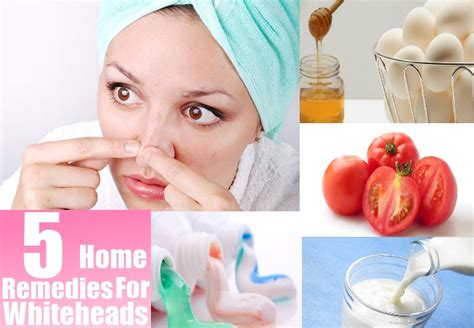 Effective Home Remedies For Whiteheads Girls Mag