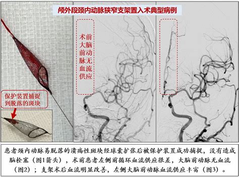 脑血管狭窄球囊扩张与支架置入术 神经血管介入中心 北京老年医院