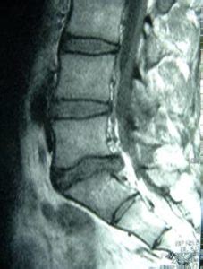 Ruptured Disc Pain & Solutions | AllSpine