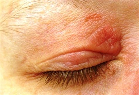 psoriasis eyelid - pictures, photos