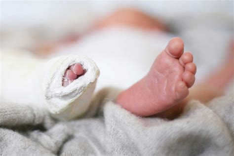 Ponseti Clubfoot Casting Southern California Foot And Ankle Specialists