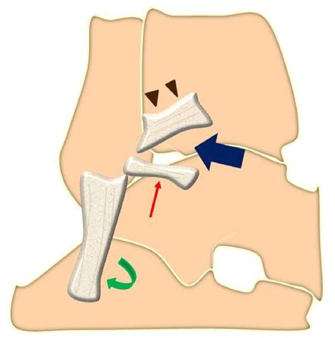 Figure 1 From Mri Imaging Of Impingement Syndromes Of The Ankle