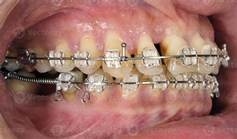 tratamiento de ortodoncia con recesión gingival 1002160 Foto de stock