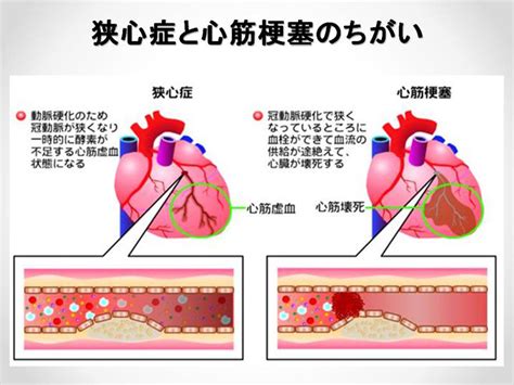 狭心症・心筋梗塞の予防と最新治療 ～あなたも発症予備軍かも！？～ らくわ健康教室 講演録