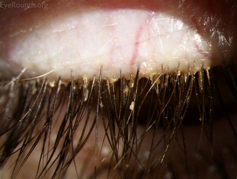 Blepharitis