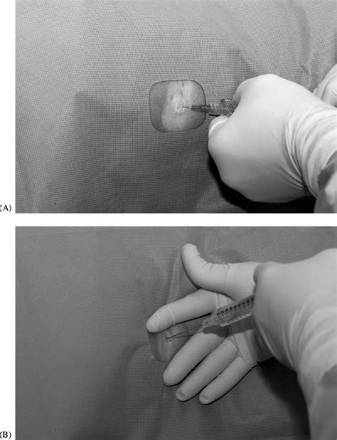 Administering Local Anesthesia A Subcutaneous Infiltration Of 1