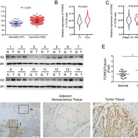 Foxk Was Up Regulated In Papillary Thyroid Cancer A The Mrna