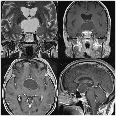 Preoperative Mri Scans Show X Cm Large Cystic Craniopharyngioma