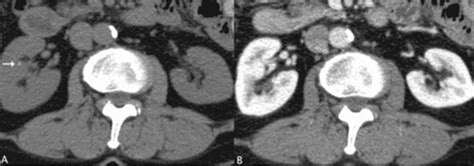 Scielo Brasil When The Non Contrast Enhanced Phase Is Unnecessary