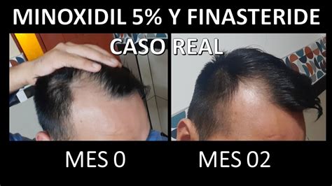 Algebraico De Nada Paraguas Minoxidil Finasteride Senado Nuestra Reba O