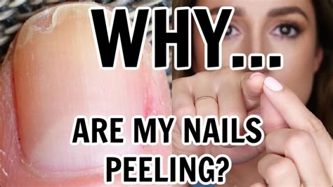 Stop The Peeling Of Your Nails Youtube