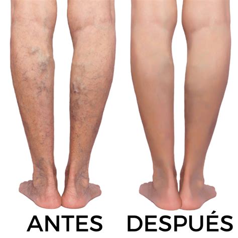 Texas Vein Experts 1 Especialista en várices de DFW