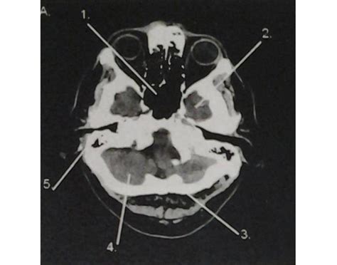 CT Head Anatomy A Quiz