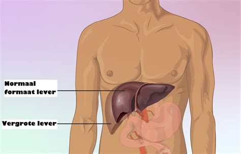 Vergrote Lever Symptomen En Behandeling Mens Gezondheid