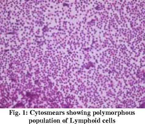 Figure 1 From Castlemans Disease Of Submandibular Region A Rare Case