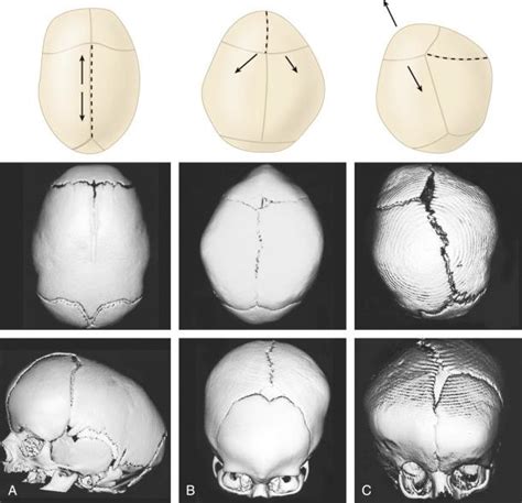 Craniosynostosis General Clinical Tree