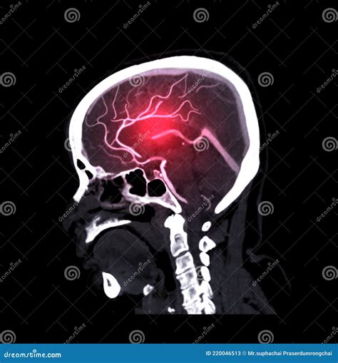 CTA Brain Or CT Angiography Of The Brain Sagittal View Medical