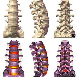 The procedure to establish the intact FE model of L1‐S1 vertebrae. A: a ...