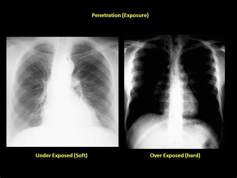 Underexposed Chest X Ray Telegraph