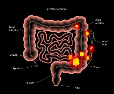 Intestine 3D cancer stock vector. Illustration of gastrointestinal ...