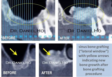 Maxillary Sinus Bone Grafting Dr Coker Dr Ho