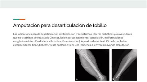 Amputaci N Transtibial Y De Tobillo Pptx