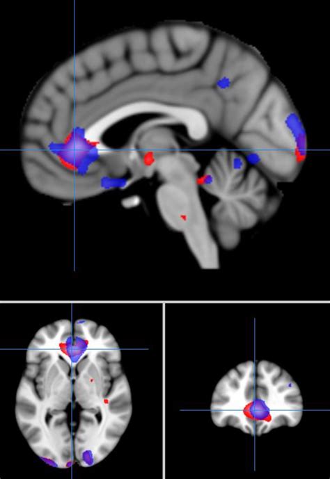 Figure 2 from Deactivation in Anterior Cingulate Cortex during facial ...