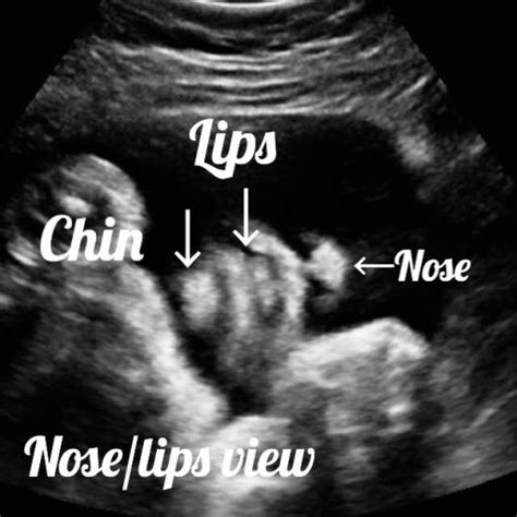 Normal 34 Week Pregnancy And Ultrasound Your Complete Guide