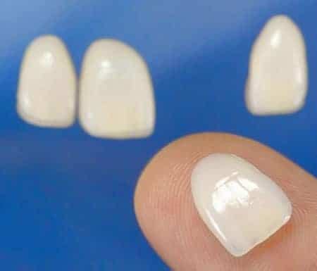 Tipos De Carillas Dentales Resinas Composite Porcelana Cl Nica