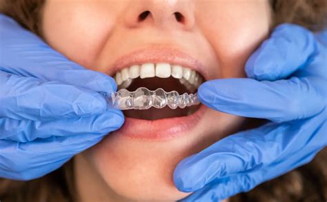 Cu L Es El Precio De Invisalign Ferrus Bratos