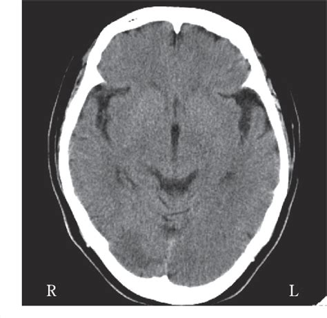 Figure 1 from Posterior Cerebral Artery Occlusion treated with ...