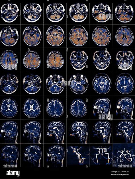 Pet Scan Brain Color Brain Hi Res Stock Photography And Images Alamy