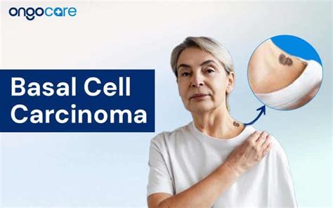 Understanding Basal Cell Carcinoma: Causes, Symptoms, & Diagnosis