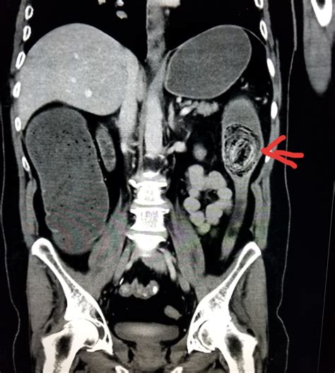 Pet Ct Scan For Stomach Cancer at Fernando Smith blog