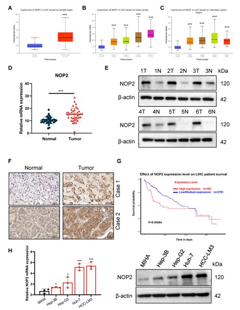 Upregulation Of Nop In Hcc A Nop Expression In Normal Tissues And Hcc