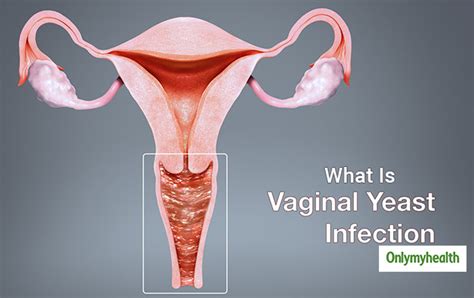 Vaginal Infections And Irritations | Hot Sex Picture