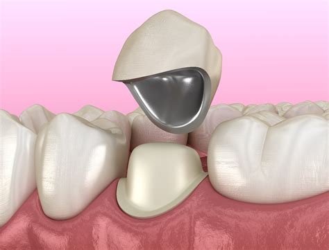 Cheap Dental Crown Restoration