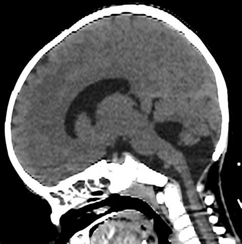 Dandy Walker Variant Image Radiopaedia Org